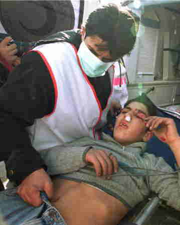 26日、ラマラ(Ramallah)のデモでイスラエル兵のゴム弾で顔を撃たれた少年、ほか50人以上の参加者が負傷した。